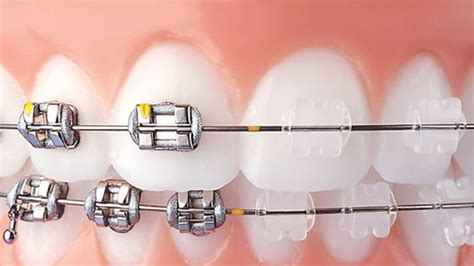 diferencia entre brackets metalicos y ceramicos|Brackets Cerámicos Y Metálicos: 7 Puntos De .